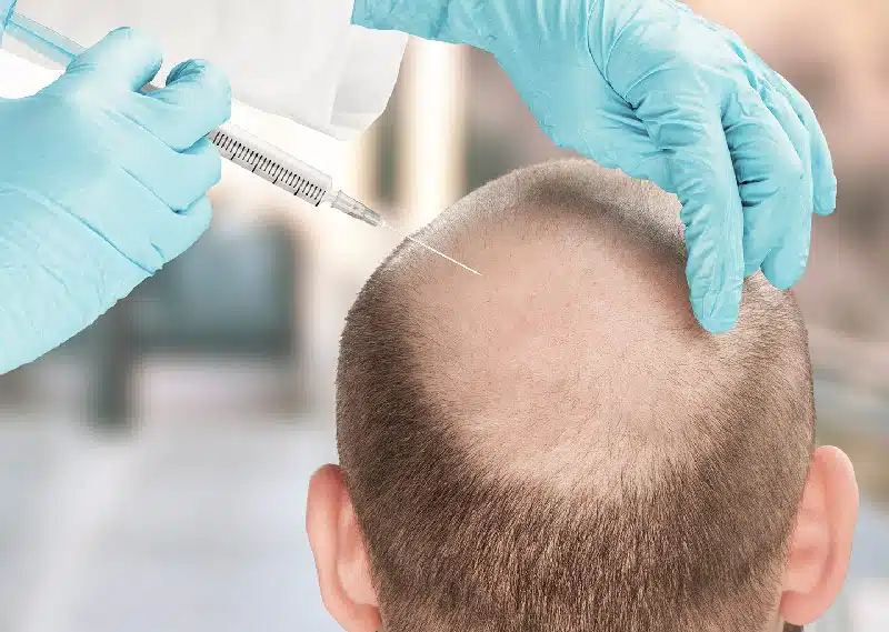 ste cells for hair loss and alopesia