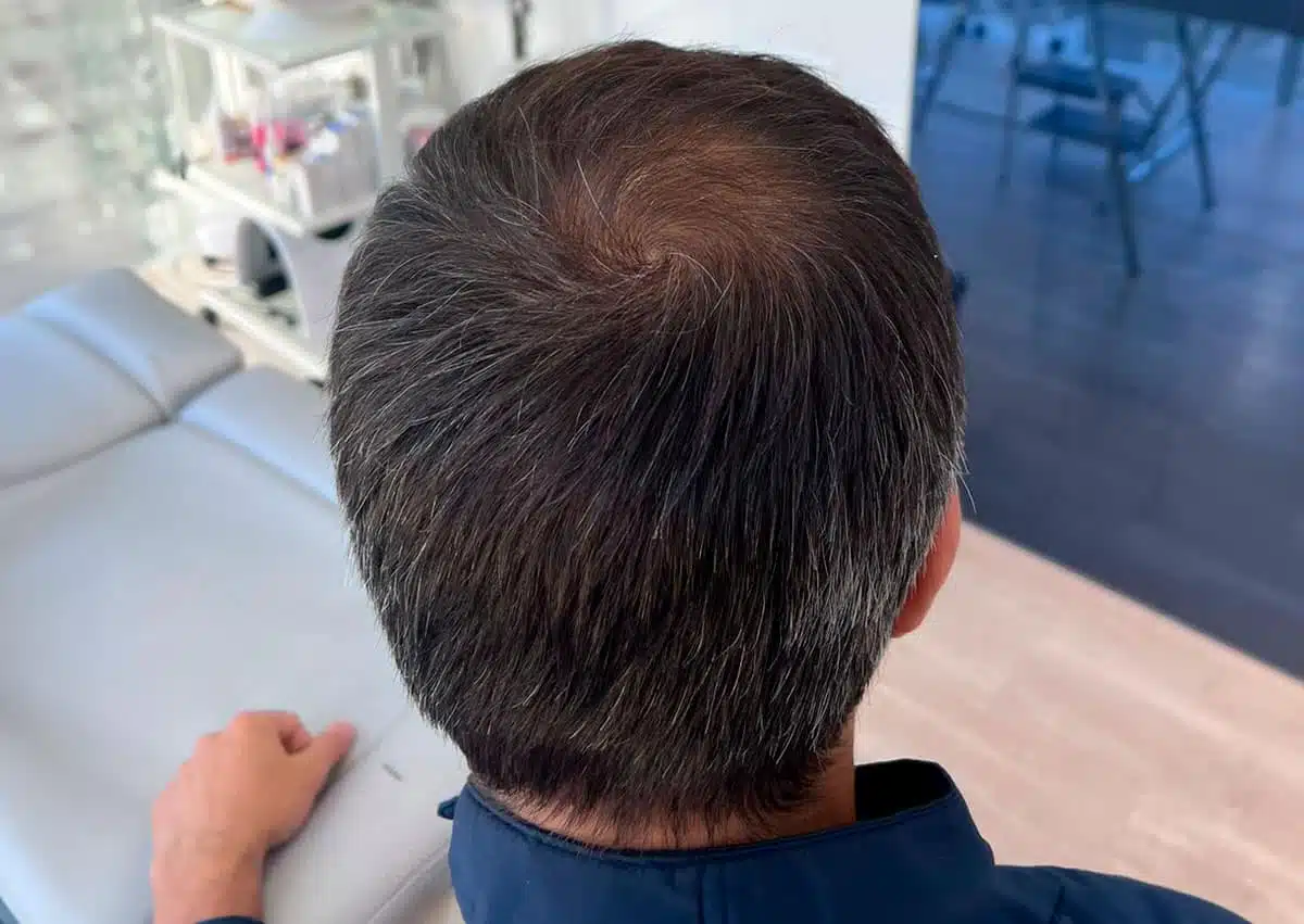 hair loss stem cells after