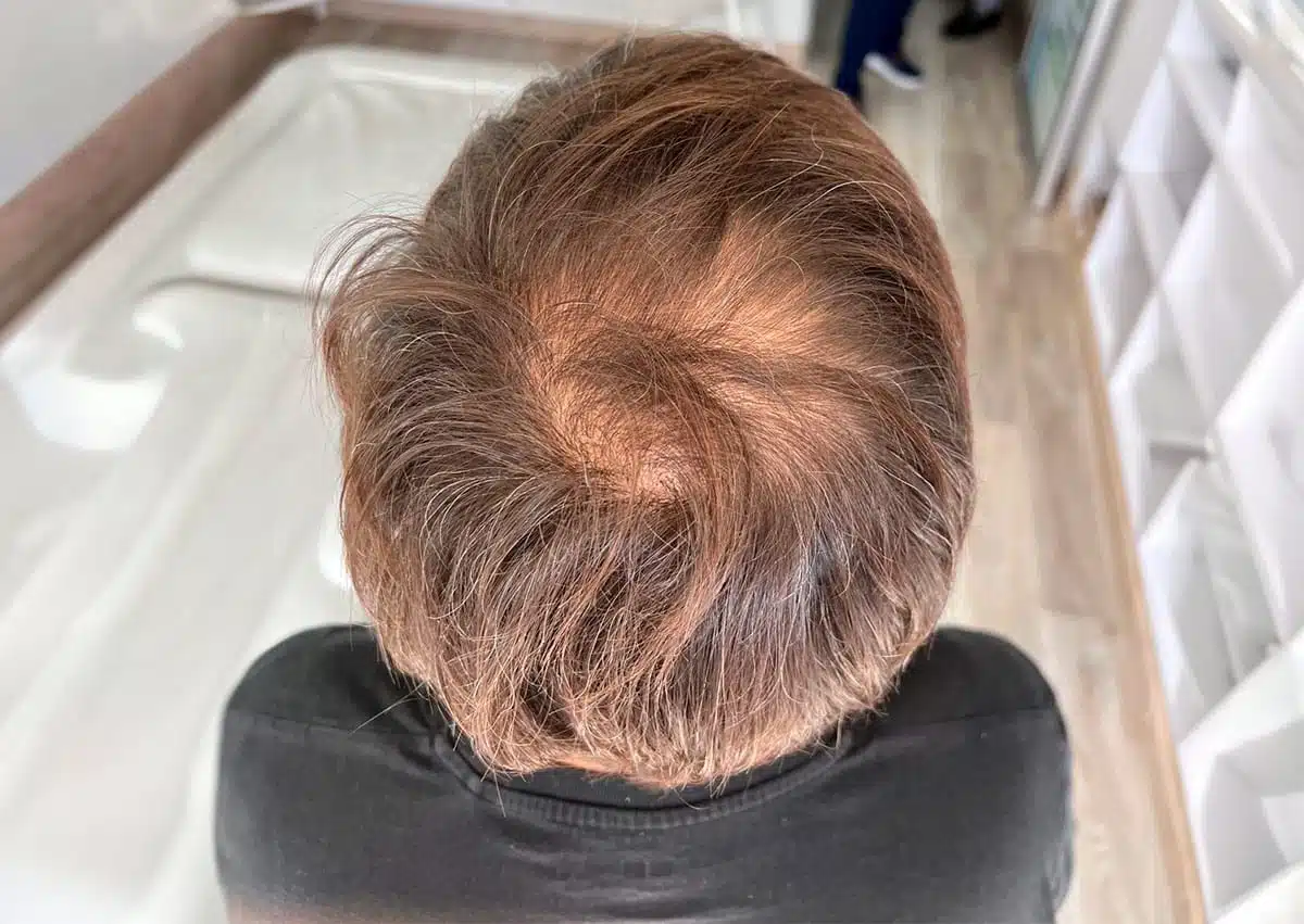 stem-cell-hair-loss-teraphy-before